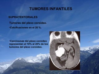 TUMORES INFANTILES SUPRATENTORIALES <ul><li>Tumores del plexo coroideo. </li></ul><ul><li>Calcificaciones en el 20  %. </l...