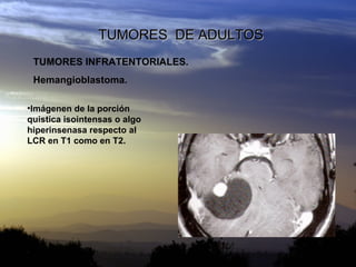 TUMORES  DE ADULTOS TUMORES INFRATENTORIALES. Hemangioblastoma. <ul><li>Imágenen de la porción quistica isointensas o algo...
