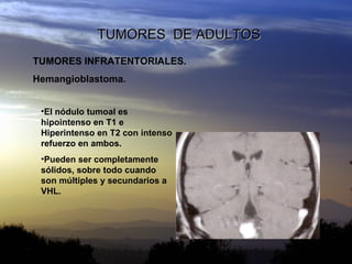 TUMORES  DE ADULTOS TUMORES INFRATENTORIALES. Hemangioblastoma. <ul><li>El nódulo tumoal es hipointenso en T1 e Hiperinten...