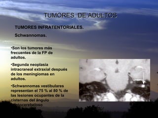 TUMORES  DE ADULTOS TUMORES INFRATENTORIALES. Schwannomas. <ul><li>Son los tumores más frecuentes de la FP de adultos. </l...