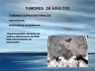 TUMORES  DE ADULTOS TUMORES SUPRATENTORIALES . Astrocitoma. Astrocitoma anaplásicos. <ul><li>Espectroscopia: aumento de co...