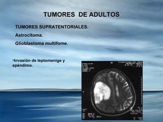 TUMORES  DE ADULTOS TUMORES SUPRATENTORIALES . Astrocitoma. Glioblastoma multifome. <ul><li>Invasión de leptomenige y epén...