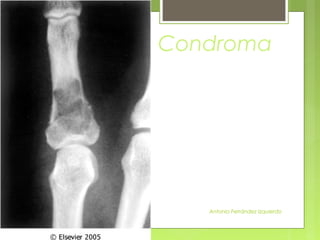 Antonio Ferrández Izquierdo
Condroma
 