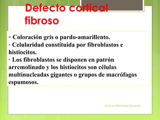 Antonio Ferrández Izquierdo
- Coloración gris o pardo-amarillento.
- Celularidad constituida por fibroblastos e
histiocitos.
- Los fibroblastos se disponen en patrón
arremolinado y los histiocitos son células
multinucleadas gigantes o grupos de macrófagos
espumosos.
Defecto cortical
fibroso
 