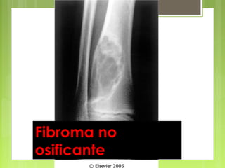 Antonio Ferrández Izquierdo
Fibroma no
osificante
 
