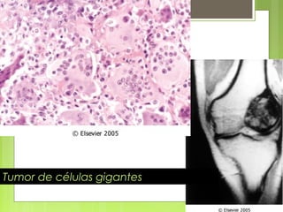 Antonio Ferrández Izquierdo
Tumor de células gigantes
 