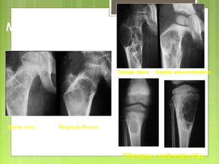 Fibromas condromixoides
Metáfisis
Quiste óseo Quiste aneurismático
Quiste óseo Displasia fibrosa
 