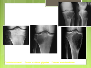 Condroblastomas Tumor a células gigantes Quistes aneurismáticos
Epífisis
 