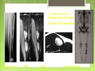Radiografía RMN TDM Centellografía
Mujer de 30 años :
Dolor a la marcha
Displasia fibrosa
Diáfisis
 