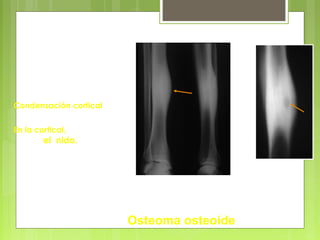 Condensación cortical
En la cortical,
el nido.
Diáfisis
Osteoma osteoide
 