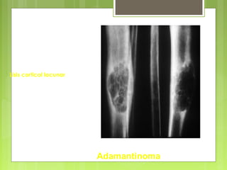 Lisis cortical lacunar
Diáfisis
Adamantinoma
 