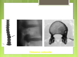 Columna Vertebral
Osteoma osteoide
 