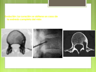 Evolución: La curación se obtiene en caso de
la exéresis completa del nido
 
