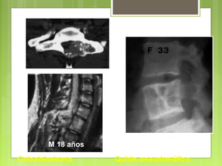 Osteoblastoma Quiste aneurismático
M 18 años
 