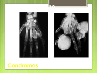 Condromas
Mano
 