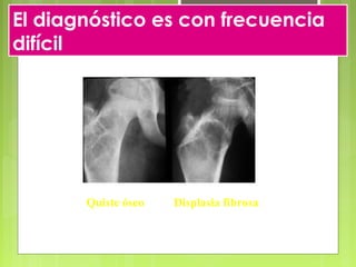 El diagnóstico es con frecuencia
difícil
Quiste óseo Displasia fibrosa
 
