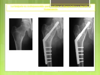 Curetaje + relleno + osteosíntesis en caso de fragilidad
La biopsia es indispensable para realizar el diagnóstico y decidir el
tratamiento
 