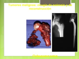 - Amputación
- Resección y
reconstrucción
(por prótesis)
Osteosarcoma
Tumores malignos: cirugía de exéresis y de
reconstrucción
 