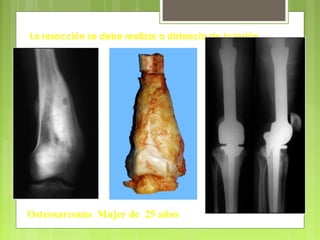 Osteosarcoma Mujer de 25 años
La resección se debe realizar a distancia de la lesión
 