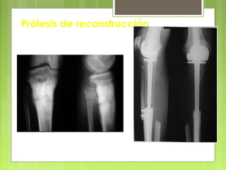 Prótesis de reconstrucción
 