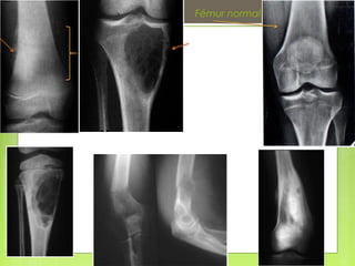 Fémur normal
 