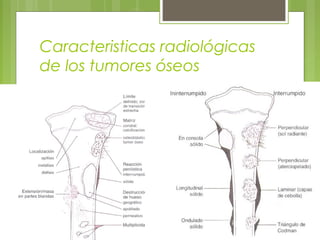 Caracteristicas radiológicas
de los tumores óseos
 