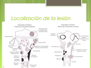 Localización de la lesión
 