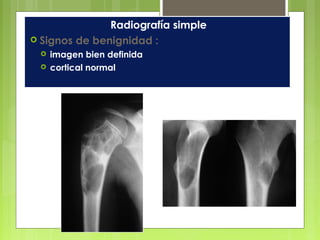 Radiografía simple
 Signos de benignidad :
 imagen bien definida
 cortical normal
 