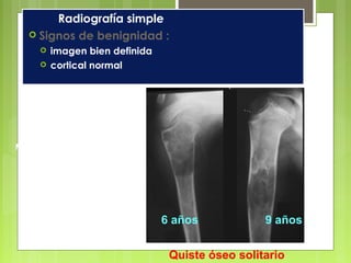 Radiografía simple
 Signos de benignidad :
 imagen bien definida
 cortical normal
Quiste óseo solitario
Migración hacia la diáfisis con
el crecimiento
6 años 9 años
 