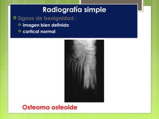 Osteoma osteoide
Radiografía simple
 Signos de benignidad :
 imagen bien definida
 cortical normal
 
