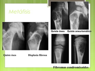 Fibromas condromixoides
Metáfisis
Quiste óseo Quiste aneurismático
Quiste óseo Displasia fibrosa
 