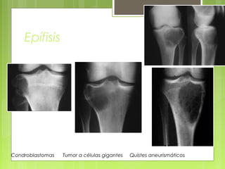 Condroblastomas Tumor a células gigantes Quistes aneurismáticos
Epífisis
 