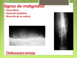 Signos de malignidad
 Zonas líticas
 Reacción perióstica
 Efracción de la cortical
 Imagen de osificaciones de partes blandas
Osteosarcomas
 