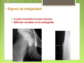 Condrosarcoma periférico
 Invasión inmediata de partes blandas
 Difícil de visualizar en la radiografía
• Signos de malignidad
 
