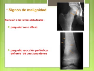 Atención a las formas debutantes :
 pequeña zona difusa
 pequeña reacción perióstica
enfrente de una zona densa
• Signos de malignidad
 