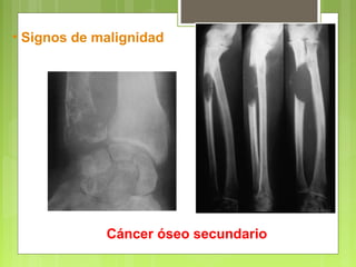 Cáncer óseo secundario
• Signos de malignidad
 