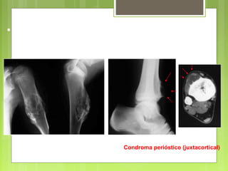 Condroma perióstico (juxtacortical)
• Invasión de partes blandas
 
