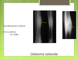 Condensación cortical
En la cortical,
el nido.
Diáfisis
Osteoma osteoide
 