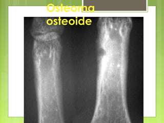 Antonio Ferrández Izquierdo
Osteoma
osteoide
 