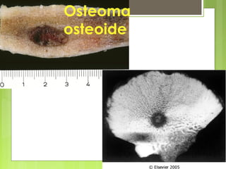Antonio Ferrández Izquierdo
Osteoma
osteoide
 