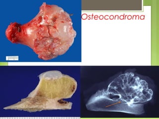 Antonio Ferrández Izquierdo
Osteocondroma
 