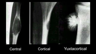 Central Cortical Yuxtacortical
 