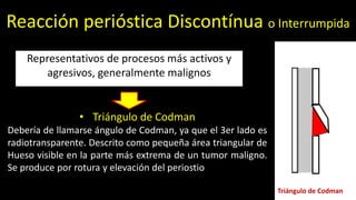 Representativos de procesos más activos y
agresivos, generalmente malignos
Reacción perióstica Discontínua o Interrumpida
• Triángulo de Codman
Debería de llamarse ángulo de Codman, ya que el 3er lado es
radiotransparente. Descrito como pequeña área triangular de
Hueso visible en la parte más extrema de un tumor maligno.
Se produce por rotura y elevación del periostio
Triángulo de Codman
 