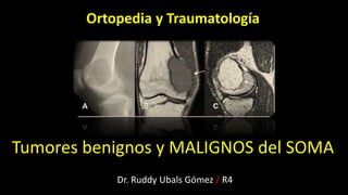 Tumores benignos y MALIGNOS del SOMA
Dr. Ruddy Ubals Gómez / R4
Ortopedia y Traumatología
 