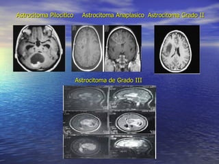 Astrocitoma Pilocitico Astrocitoma Anaplasico Astrocitoma Grado II Astrocitoma de Grado III 