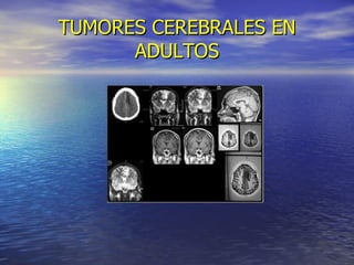 TUMORES CEREBRALES EN ADULTOS 