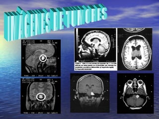 IMÁGENES DE TUMORES 