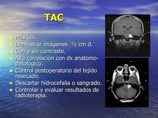 TAC Más útil. Demostrar imágenes  ½ cm d. Con o sin contraste. Alta correlación con dx anatomo-patológico. Control postoperatorio del tejido resecado. Descartar hidrocefalia o sangrado. Controlar y evaluar resultados de radioterapia. 