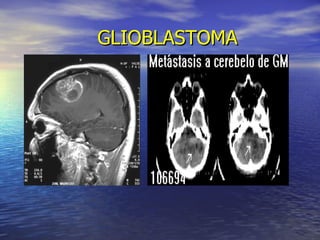 GLIOBLASTOMA 