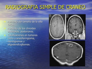 RADIOGRAFIA SIMPLE DE CRANEO Aumento del tamaño de la silla turca. Aumento de los clinoides anteriores, posteriores. Calcificaciones en tumores como craneofaringioma, meningiomas y oligodendrogliomas. 